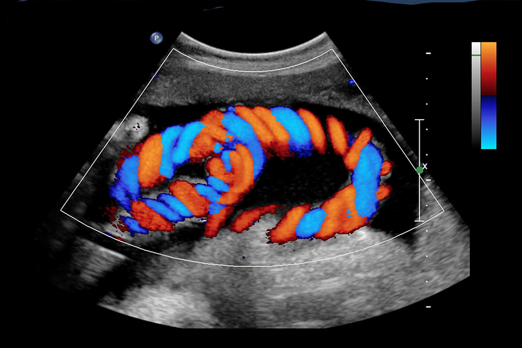 Colour Doppler